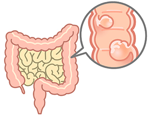 大腸ポリープは何ミリから危険？大腸がんになる確率は？