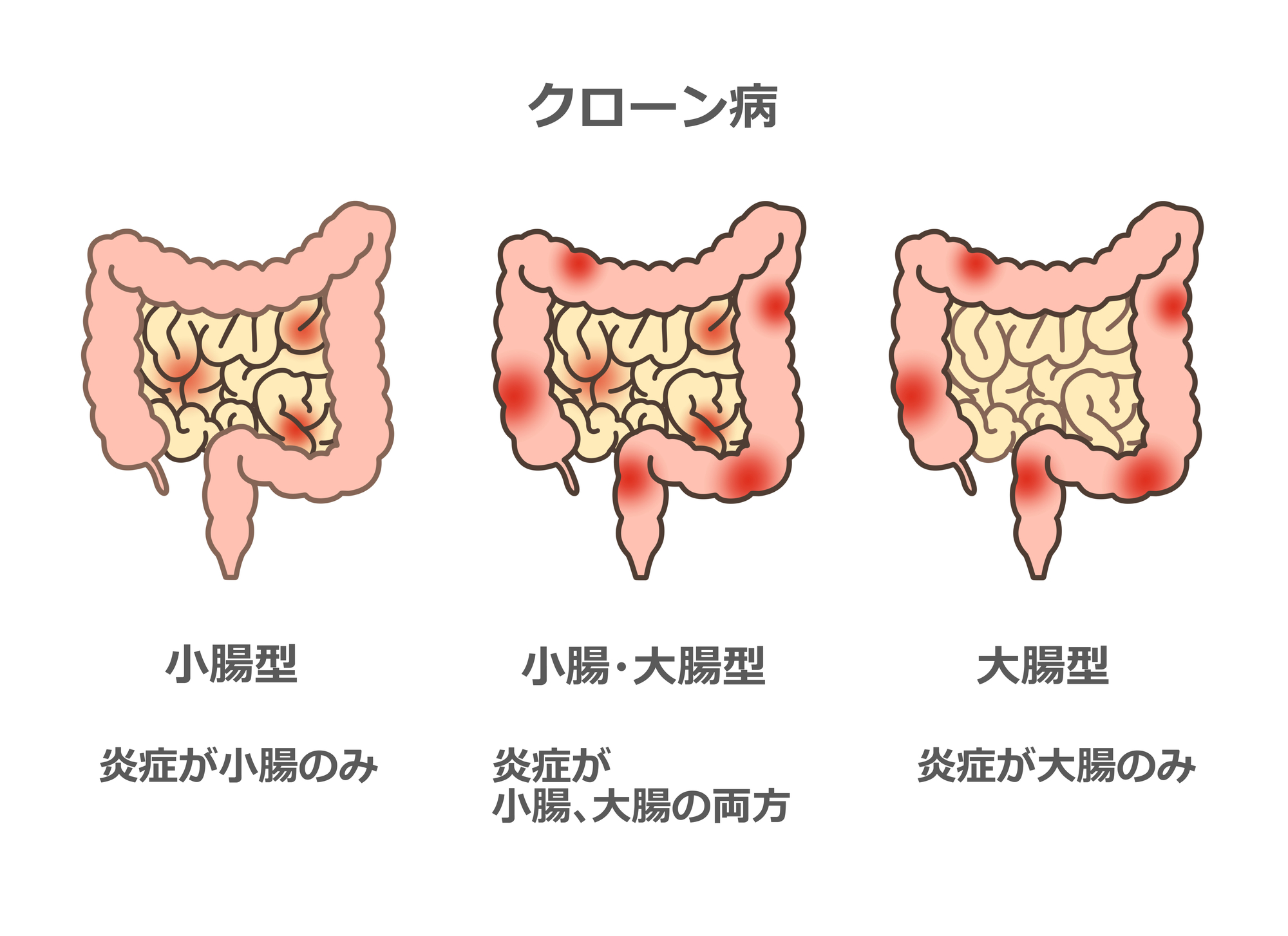 クローン病